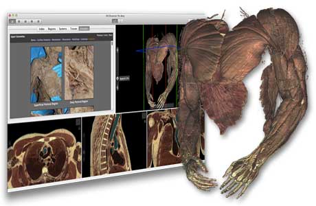 Virtual Human Dissector (VHD) with Sectra Table